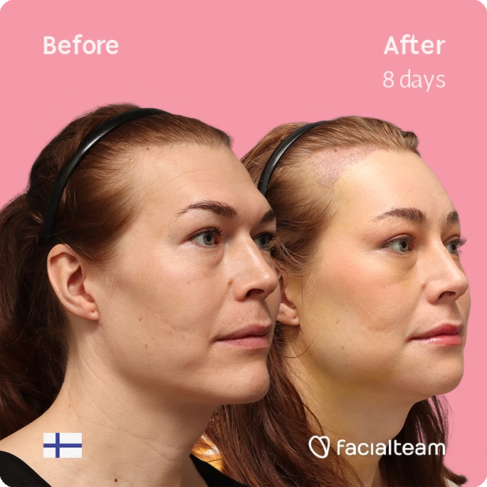 Angled right square image of FFS patient Juuli showing the results before-after with Facialteam consisting of Forehead with SHT, chin, jaw feminization surgery and HIFU as complementary procedure.