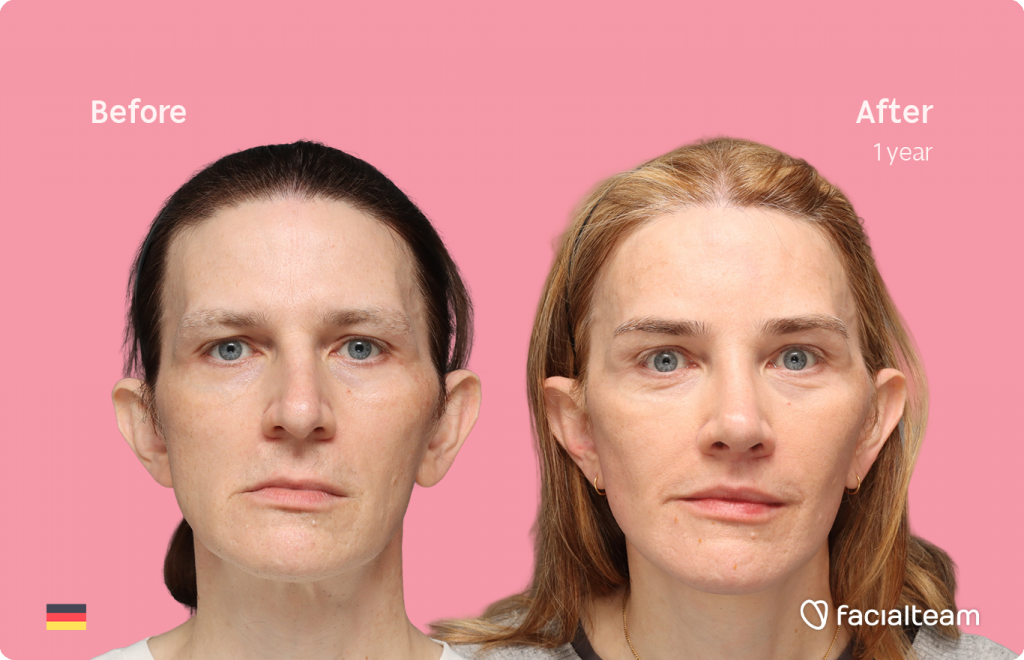 Front image of FFS patient Nina S showing the results before-after with Facialteam consisting of Forehead, Rinoplasty and tracheal shave Feminization and cervicofacial lift and lip feminization as complementary procedure.