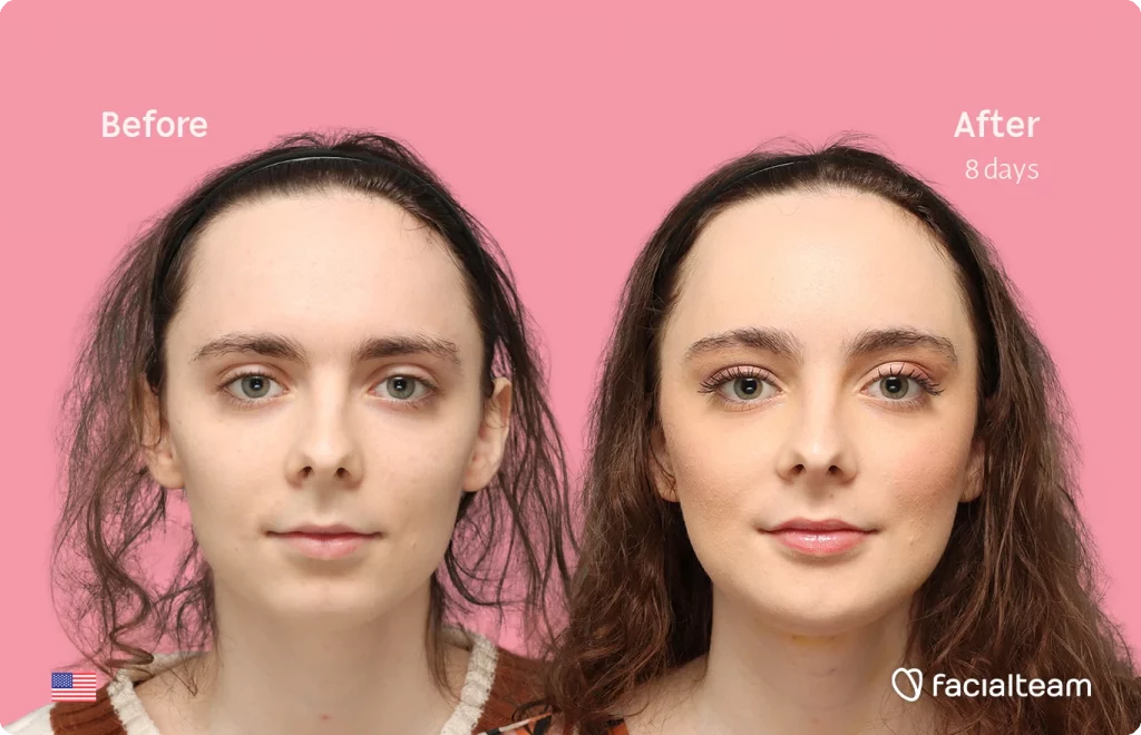 Front image of FFS patient Alex M showing the results before-after with Facialteam consisting of Forehead, chin Feminization and tracheal shave.
