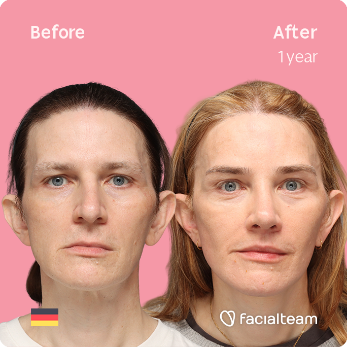 Front square image of FFS patient Nina S showing the results before-after with Facialteam consisting of Forehead, Rinoplasty and tracheal shave Feminization and cervicofacial lift and lip feminization as complementary procedure.
