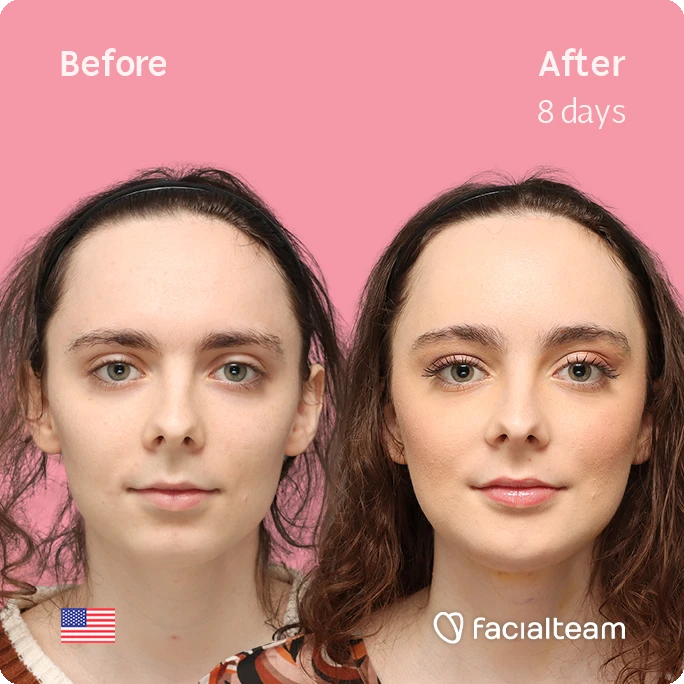 Front square image of FFS patient Alex M showing the results before-after with Facialteam consisting of Forehead, chin Feminization and tracheal shave.