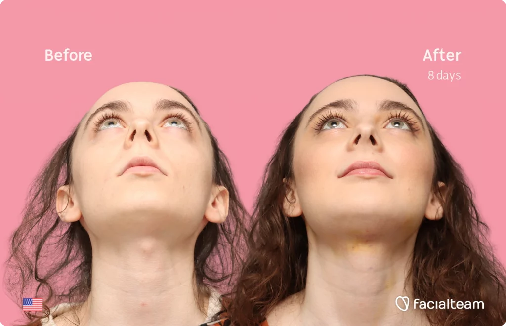 Front up image of FFS patient Alex M showing the results before-after with Facialteam consisting of Forehead, chin Feminization and tracheal shave.