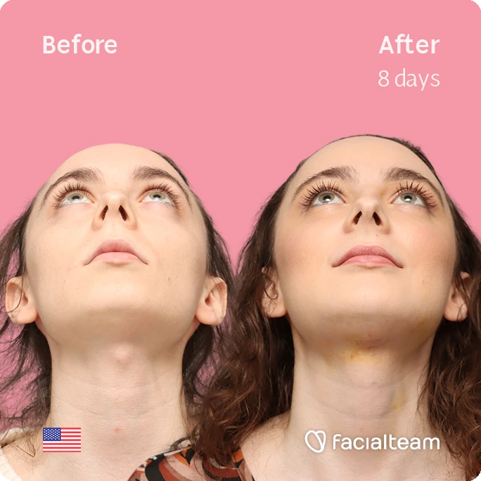 Front up square image of FFS patient Alex M showing the results before-after with Facialteam consisting of Forehead, chin Feminization and tracheal shave.