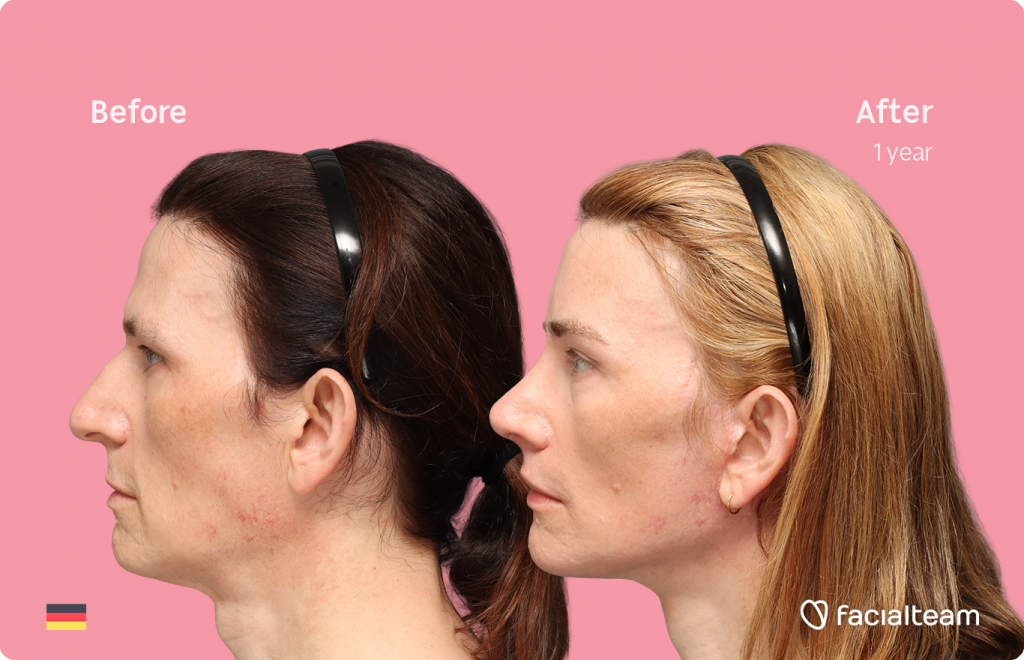 Left side image of FFS patient Nina S showing the results before-after with Facialteam consisting of Forehead, Rinoplasty and tracheal shave Feminization and cervicofacial lift and lip feminization as complementary procedure.