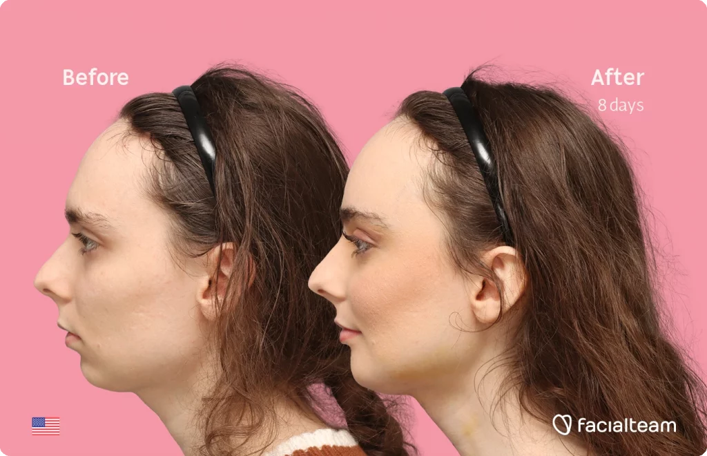 Side left image of FFS patient Alex M showing the results before-after with Facialteam consisting of Forehead, chin Feminization and tracheal shave.