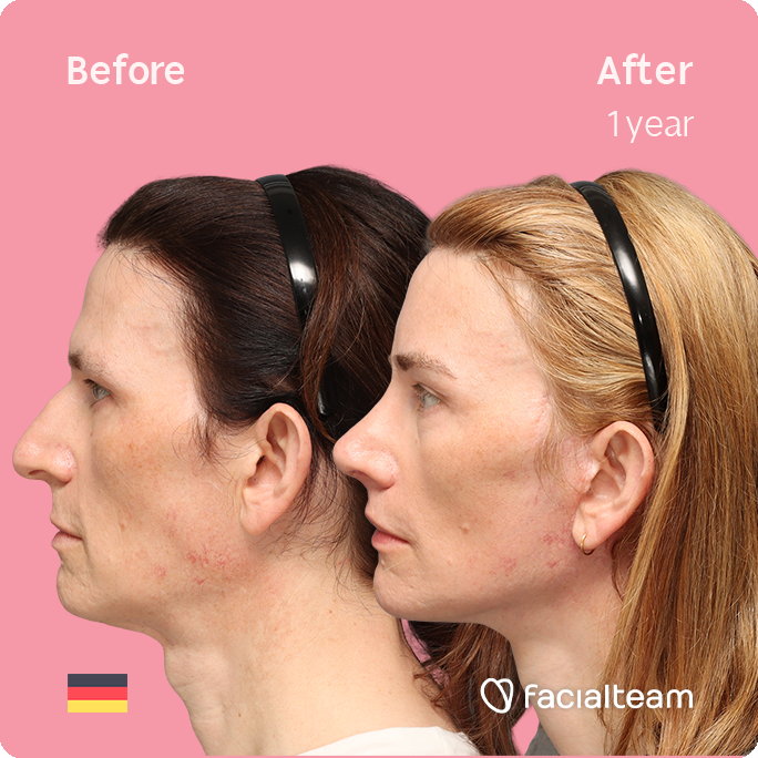 Left side square image of FFS patient Nina S showing the results before-after with Facialteam consisting of Forehead, Rinoplasty and tracheal shave Feminization and cervicofacial lift and lip feminization as complementary procedure.
