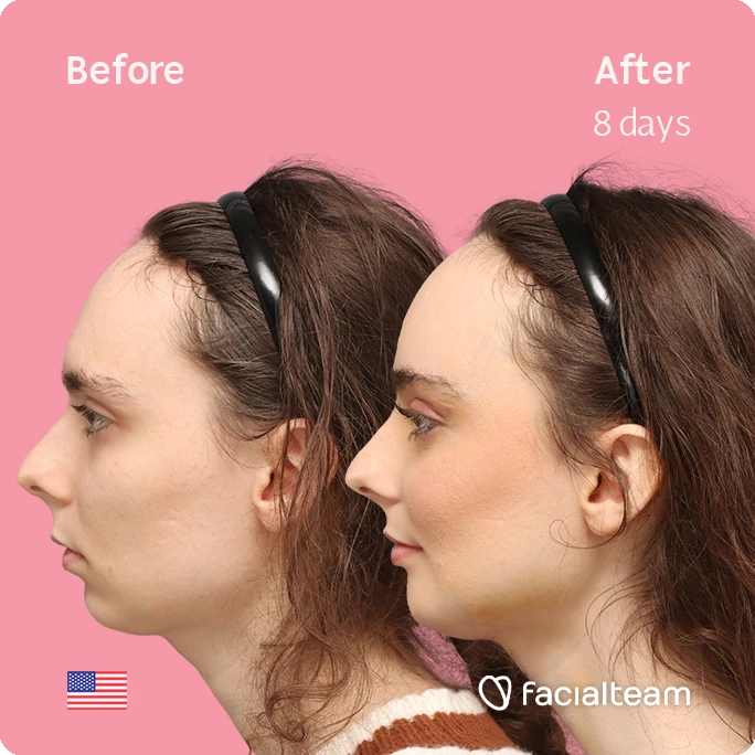Side left square image of FFS patient Alex M showing the results before-after with Facialteam consisting of Forehead, chin Feminization and tracheal shave.