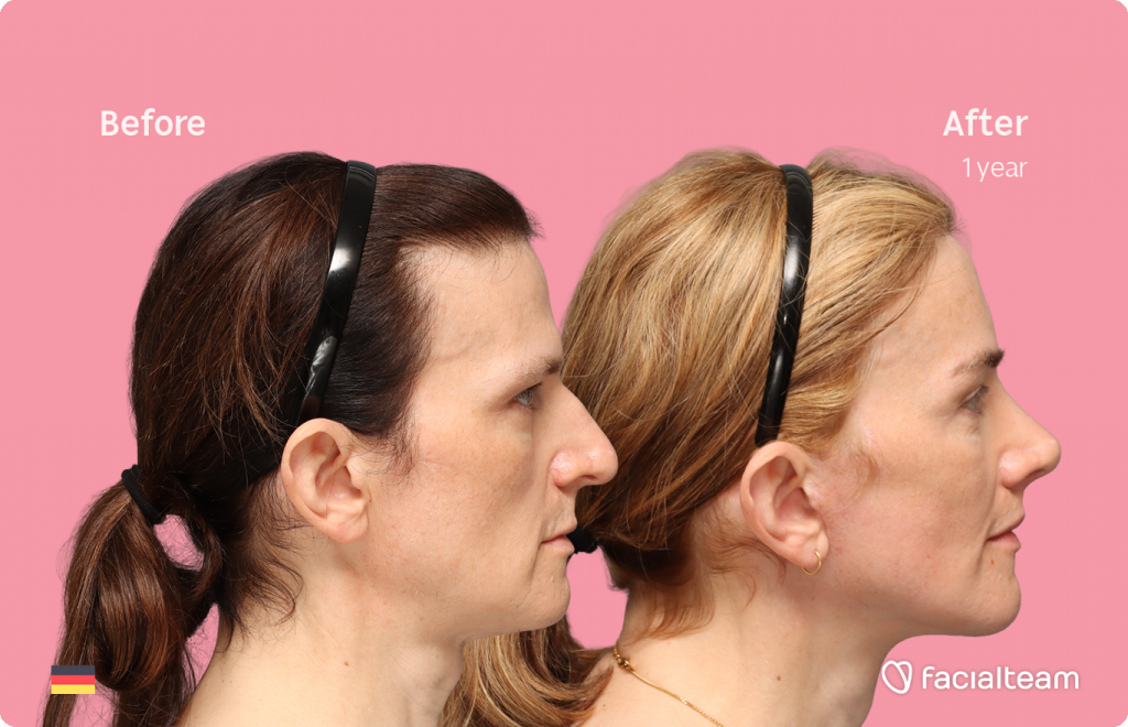Right side image of FFS patient Nina S showing the results before-after with Facialteam consisting of Forehead, Rinoplasty and tracheal shave Feminization and cervicofacial lift and lip feminization as complementary procedure.