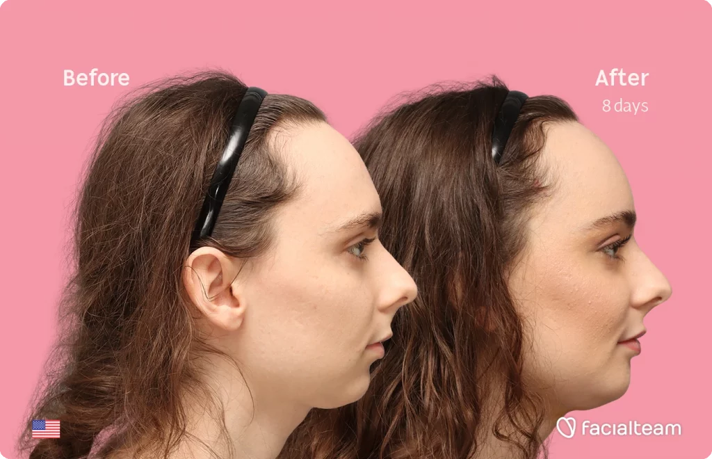 Side right image of FFS patient Alex M showing the results before-after with Facialteam consisting of Forehead, chin Feminization and tracheal shave.