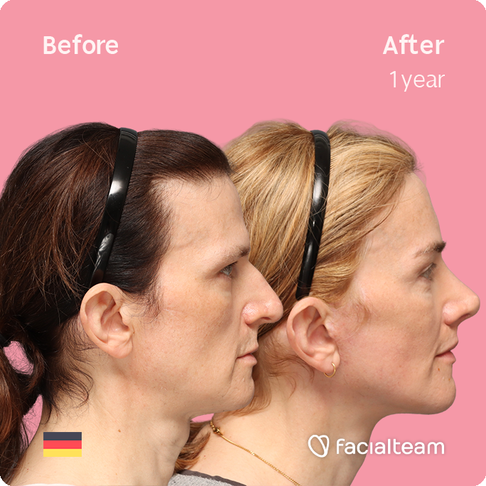 Right side square image of FFS patient Nina S showing the results before-after with Facialteam consisting of Forehead, Rinoplasty and tracheal shave Feminization and cervicofacial lift and lip feminization as complementary procedure.