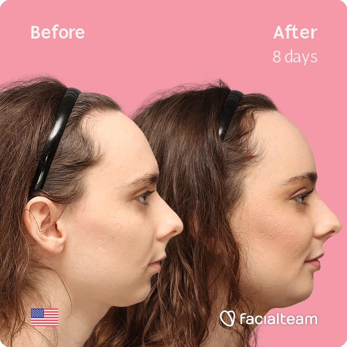 Side right square image of FFS patient Alex M showing the results before-after with Facialteam consisting of Forehead, chin Feminization and tracheal shave.