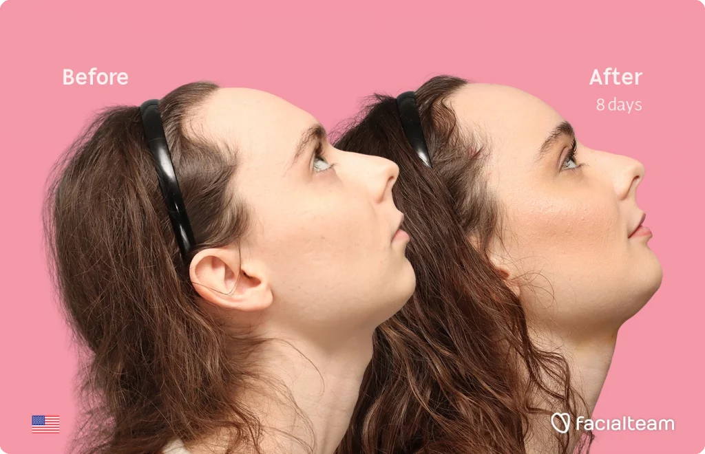 Side right up image of FFS patient Alex M showing the results before-after with Facialteam consisting of Forehead, chin Feminization and tracheal shave.