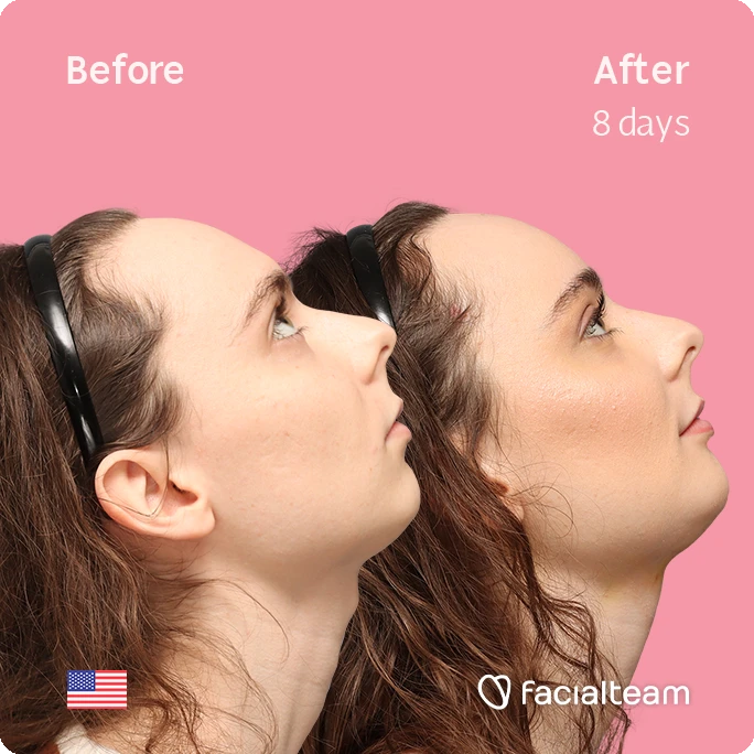 Side right up square image of FFS patient Alex M showing the results before-after with Facialteam consisting of Forehead, chin Feminization and tracheal shave.