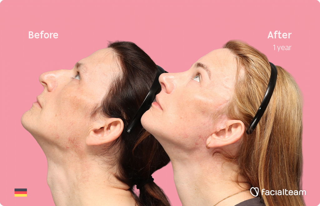 Right side up image of FFS patient Nina S showing the results before-after with Facialteam consisting of Forehead, Rinoplasty and tracheal shave Feminization and cervicofacial lift and lip feminization as complementary procedure.