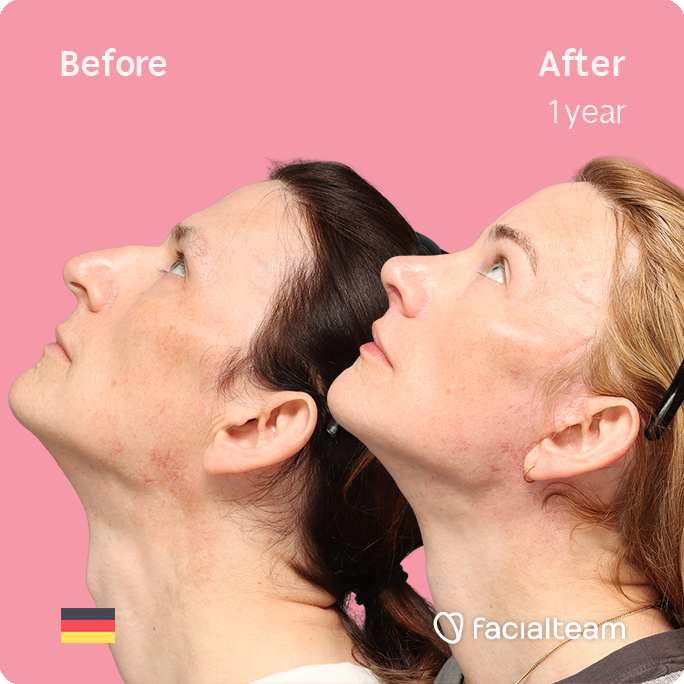Right side up square image of FFS patient Nina S showing the results before-after with Facialteam consisting of Forehead, Rinoplasty and tracheal shave Feminization and cervicofacial lift and lip feminization as complementary procedure.
