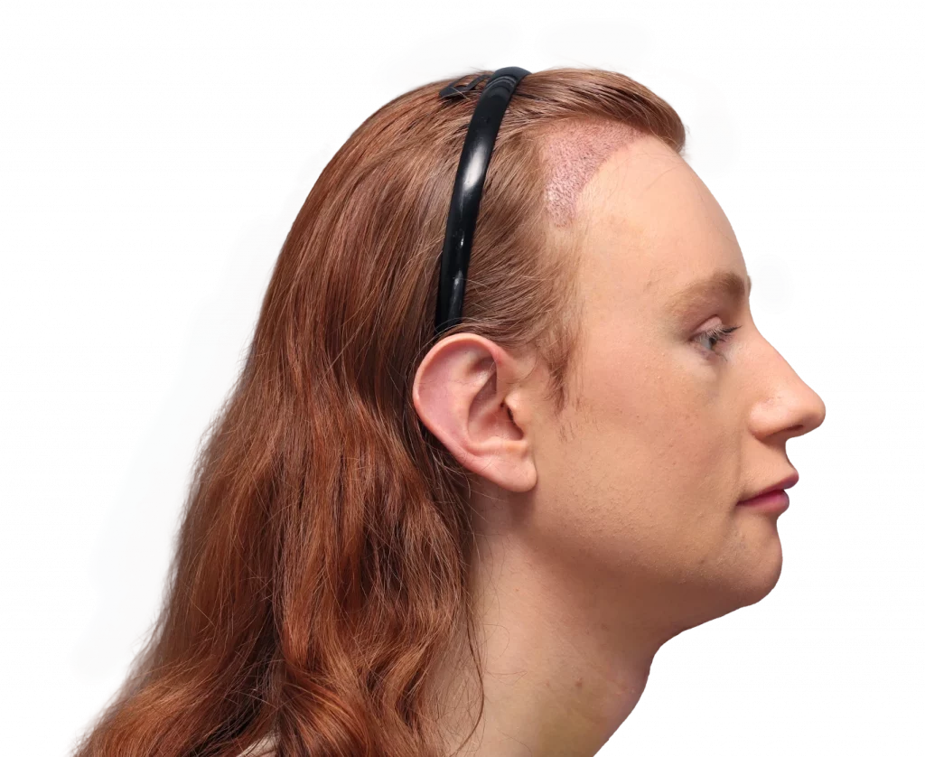 Side right profile photo of Annah after surgery.