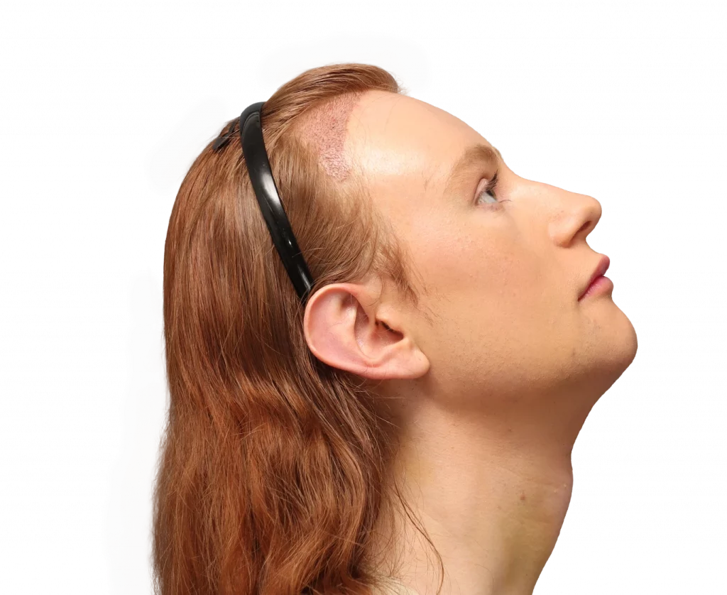 Side right up profile photo of Annah after surgery.