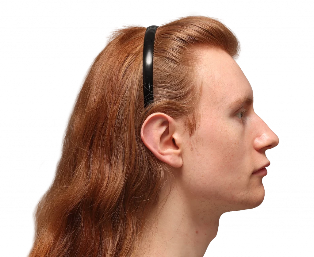 Side right profile photo of Annah before surgery.