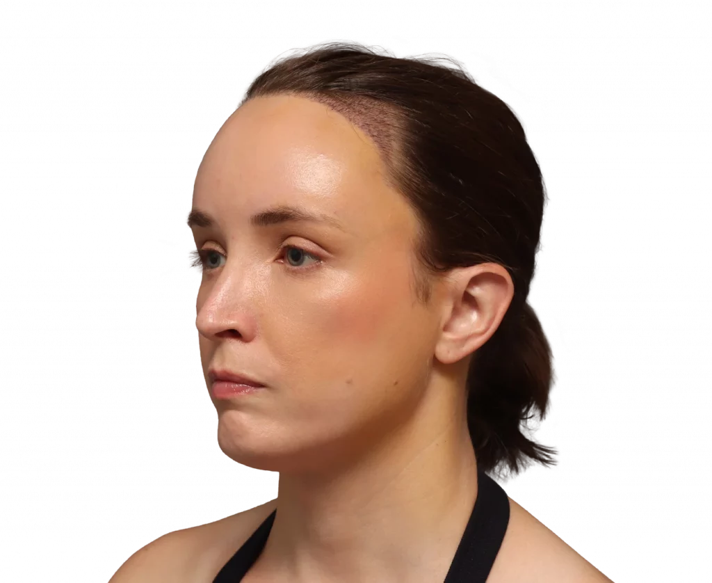 Angled left profile photo of Erin after surgery.