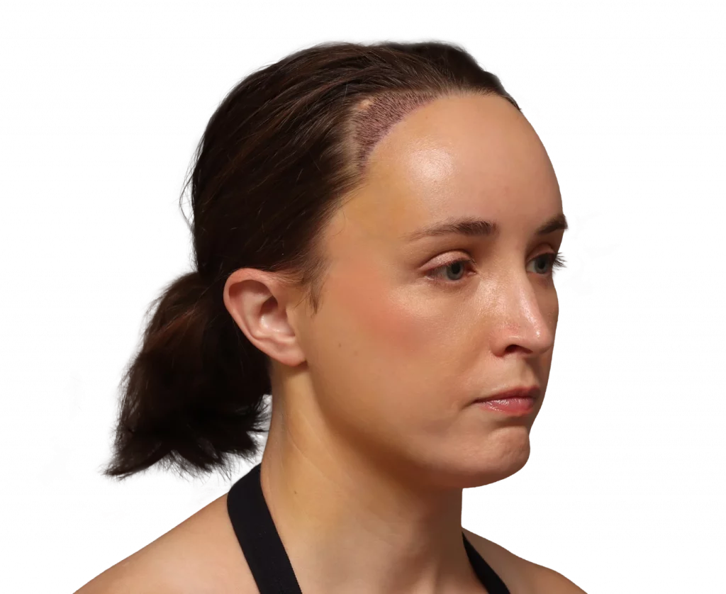 Angled right profile photo of Erin after surgery.