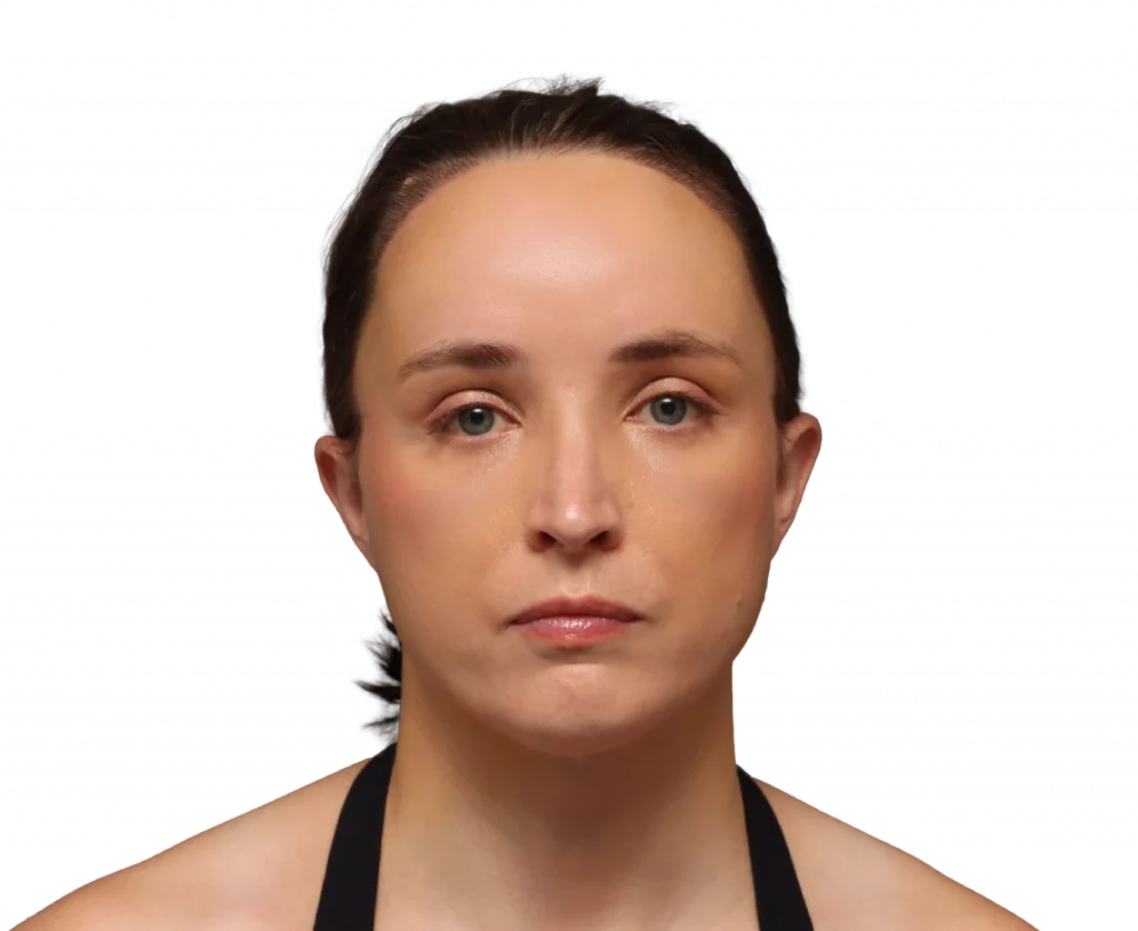 Frontal profile photo of Erin after surgery.