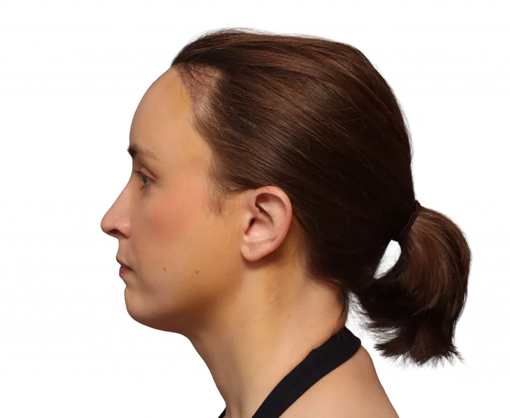 Side left profile photo of Erin after surgery.
