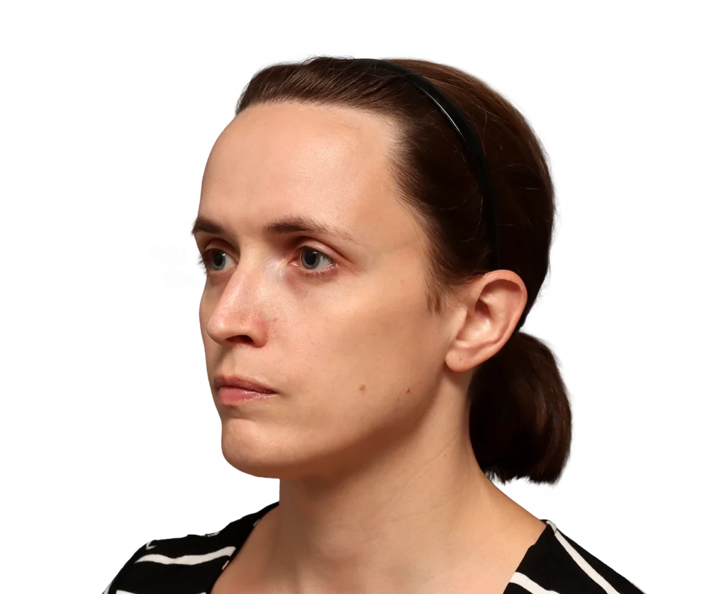 Angled left profile photo of Erin before surgery.