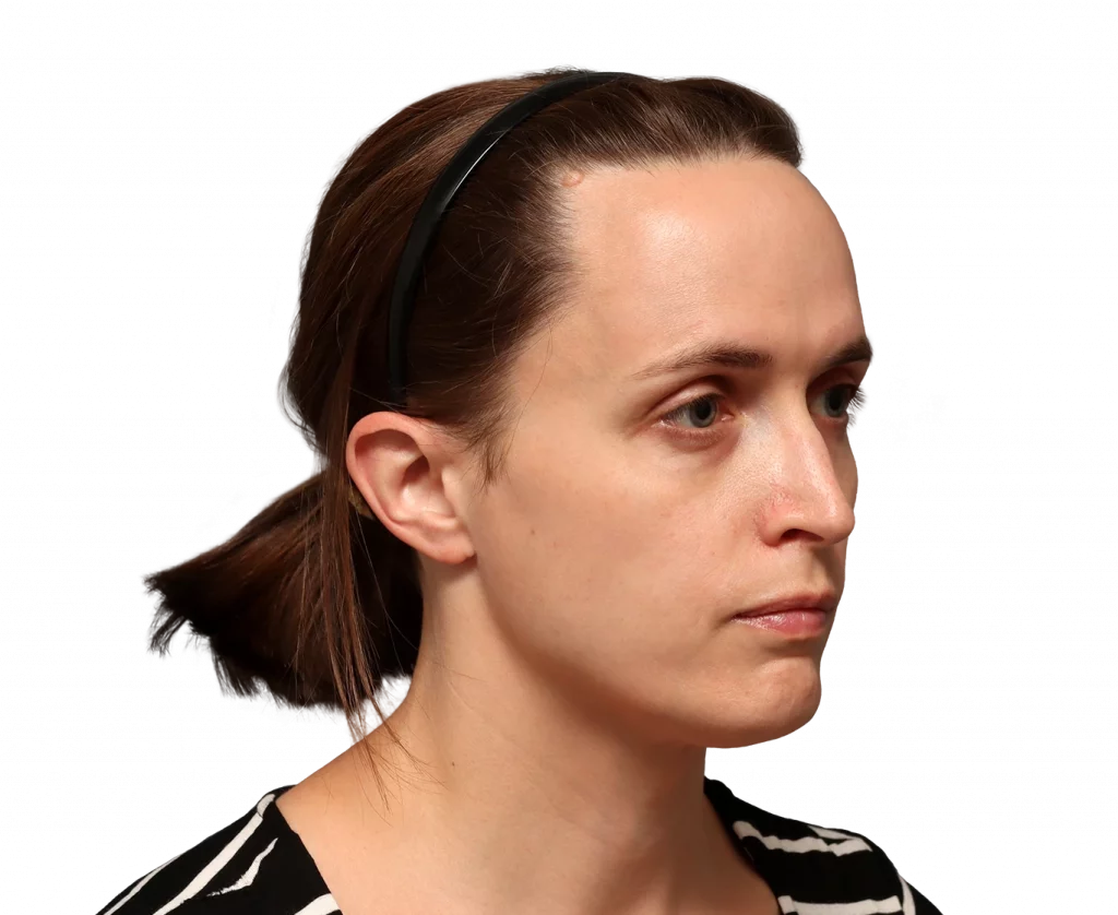 Angled right profile photo of Erin before surgery.