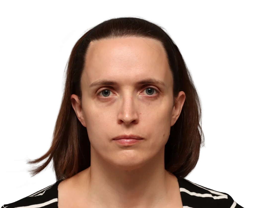 Frontal profile photo of Erin before surgery.