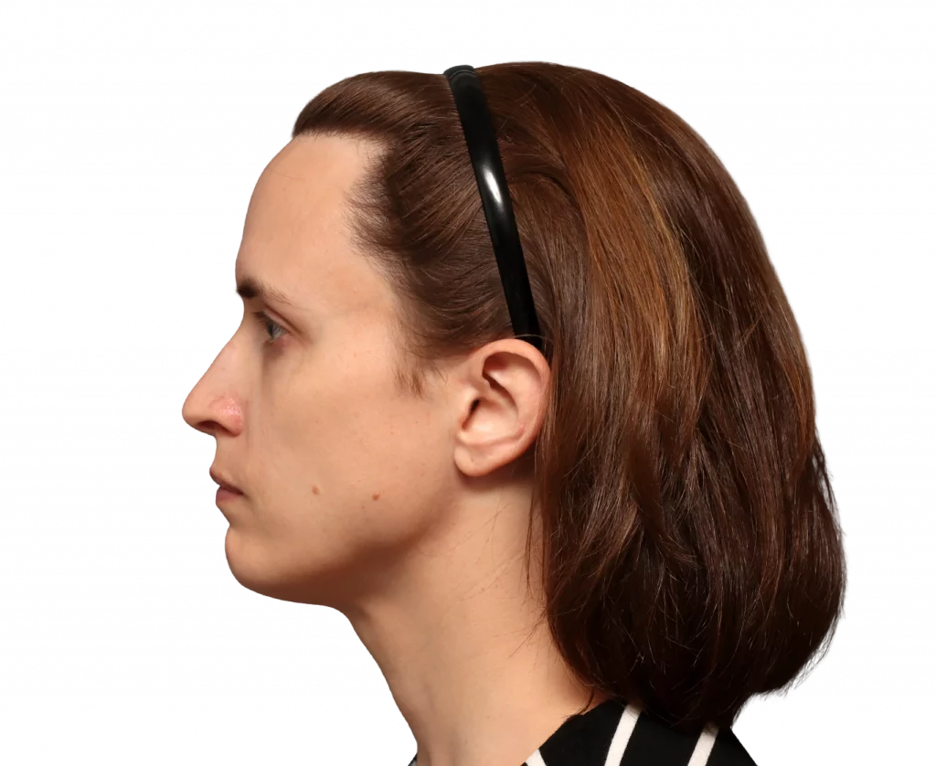 Side Left profile photo of Erin before surgery.