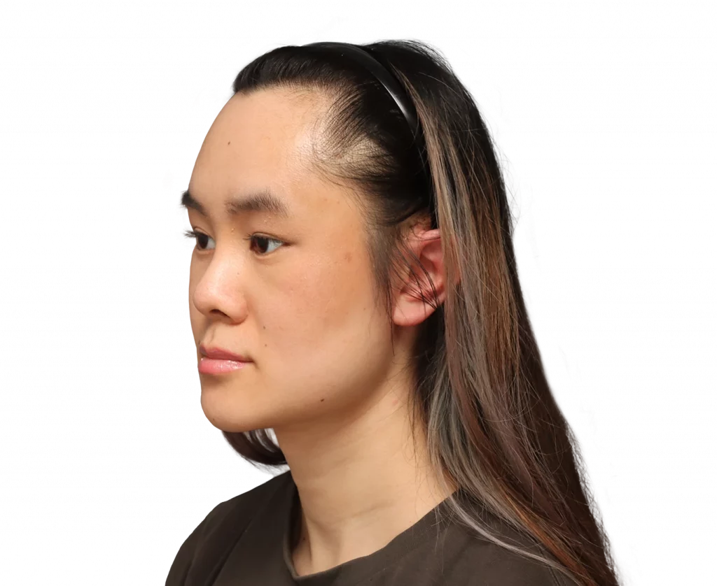 Angled left profile photo of Val after surgery.