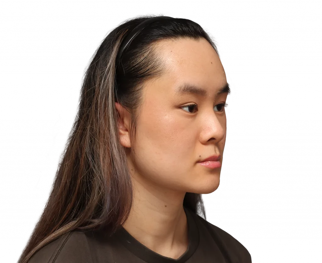 Angled right profile photo of Val after surgery.