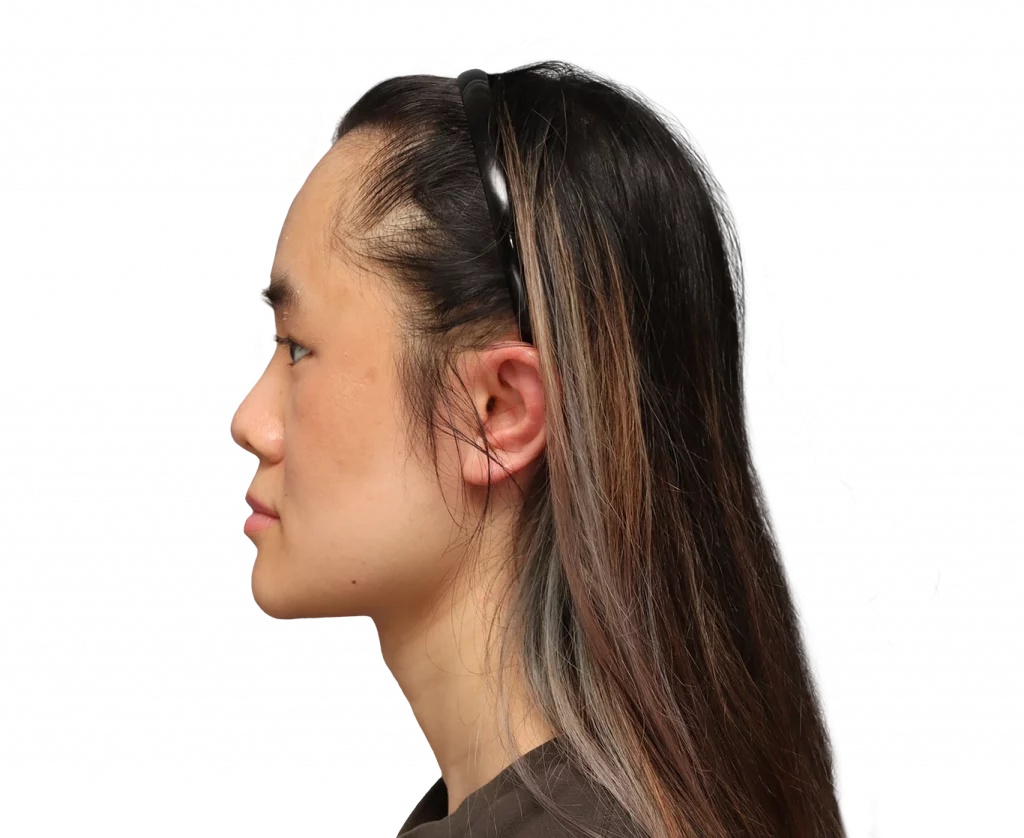 Side left profile photo of Val after surgery.