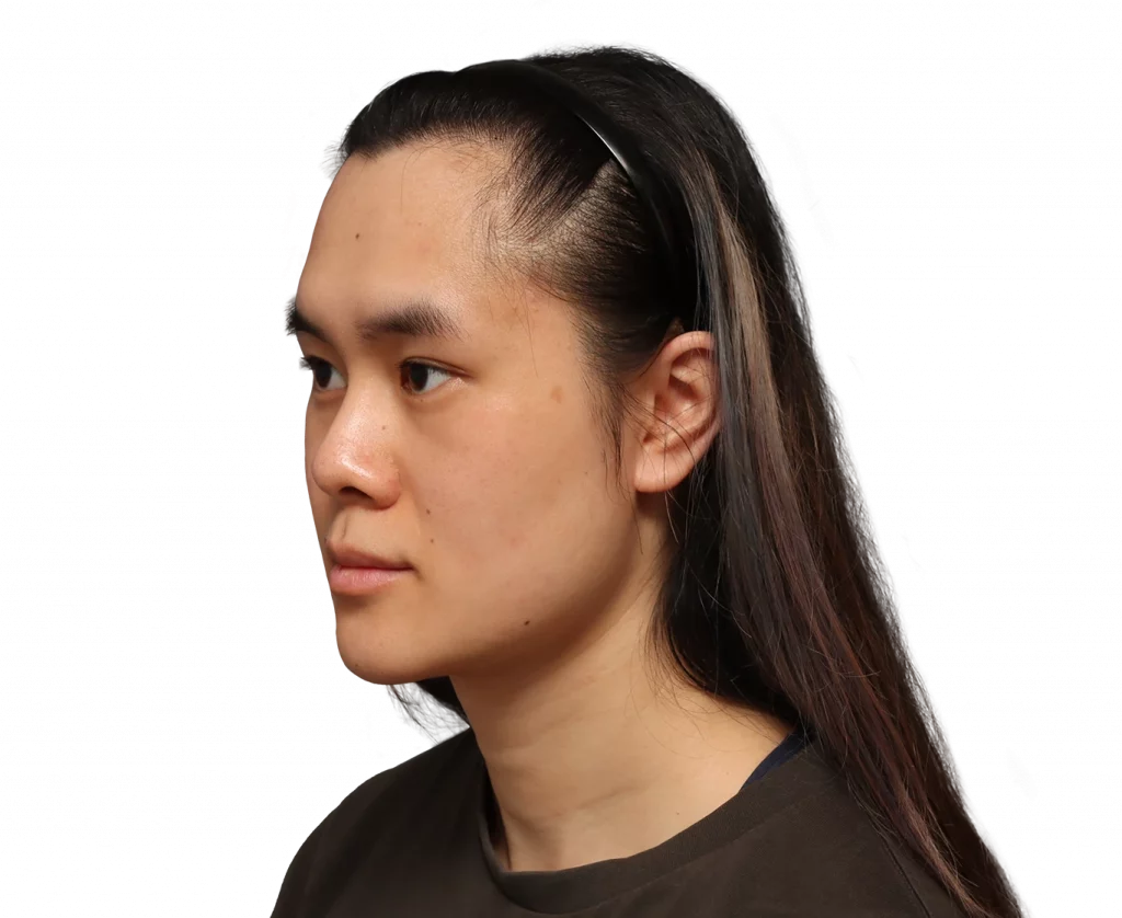 Angled left profile photo of Val before surgery.