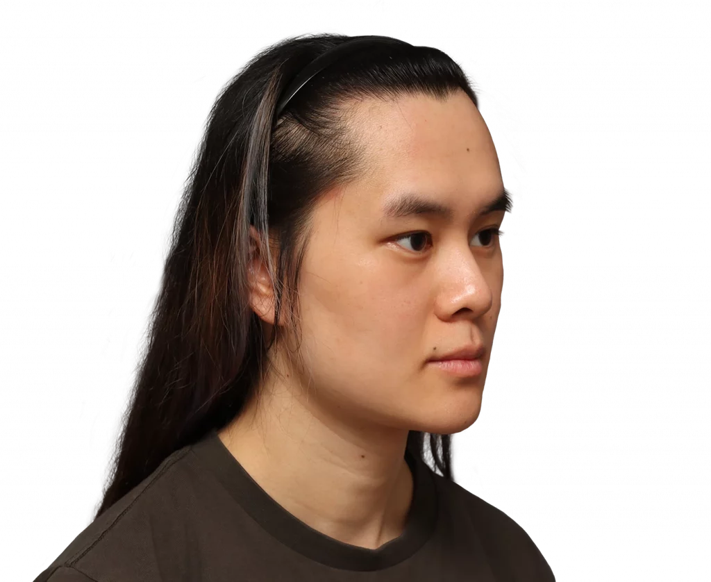 Angled right profile photo of Val before surgery.