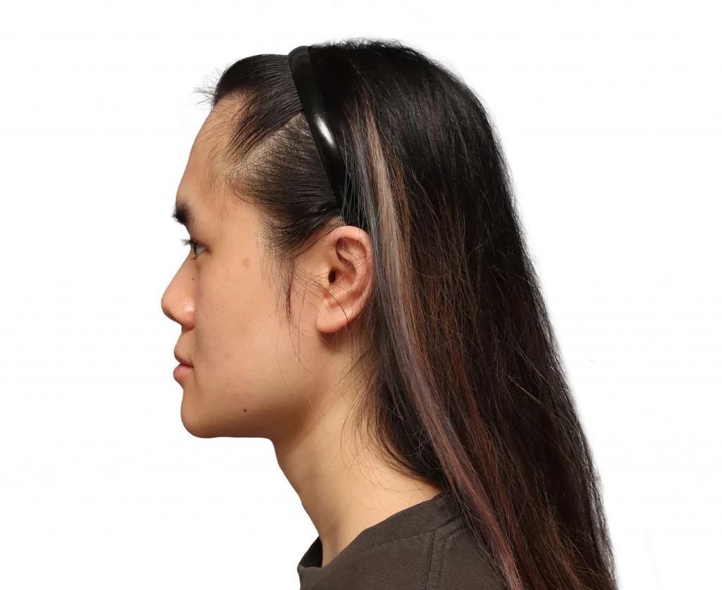 Side left profile photo of Val before surgery.