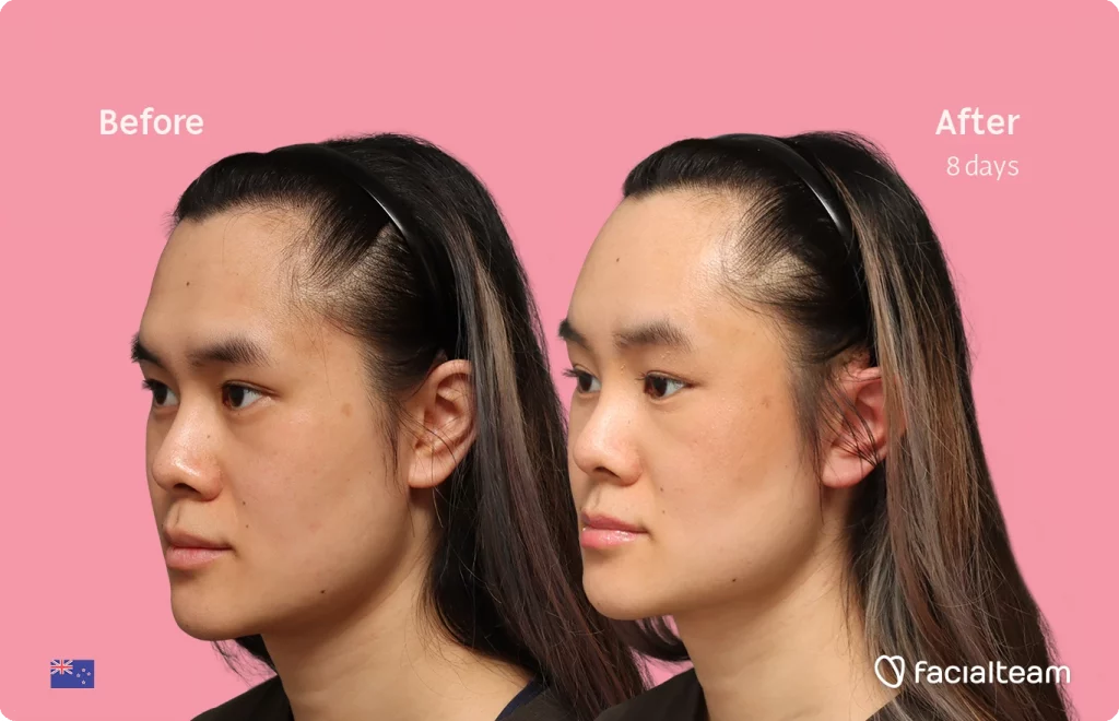 Angled left image of FFS patient Val showing the results before-after with Facialteam consisting of forehead feminization surgery.