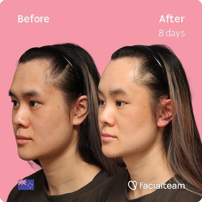Angled left square image of FFS patient Val showing the results before-after with Facialteam consisting of forehead feminization surgery.