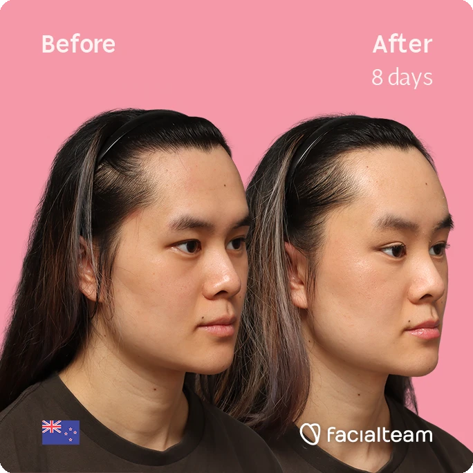 Angled right square image of FFS patient Val showing the results before-after with Facialteam consisting of forehead feminization surgery.