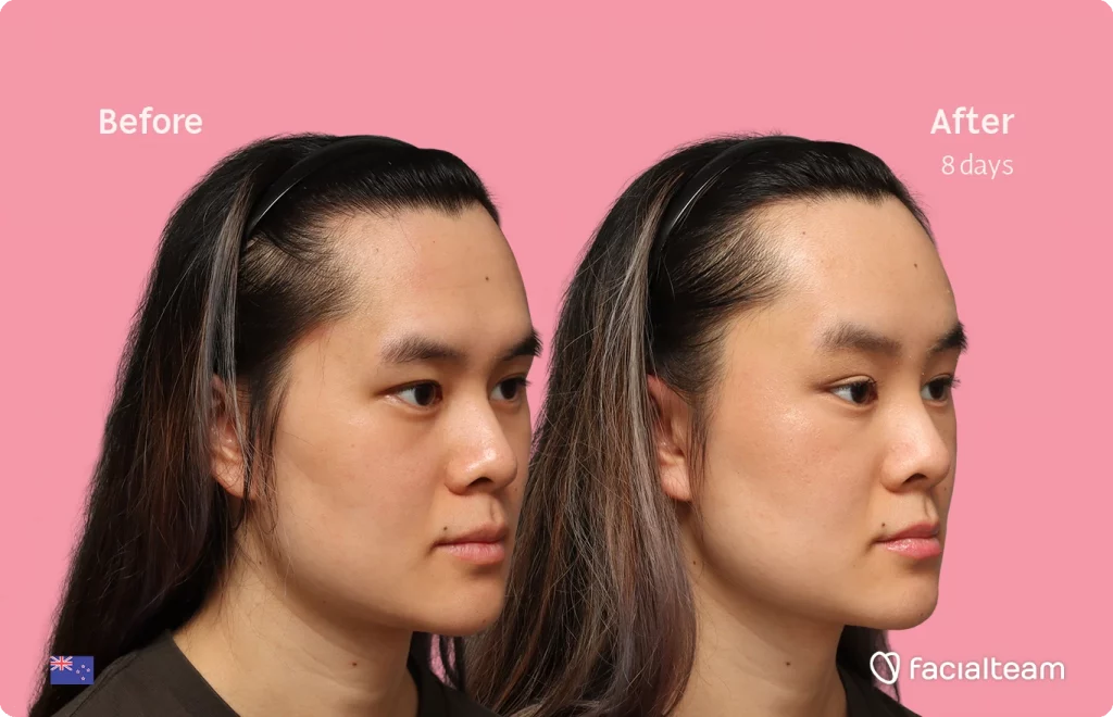 Angled right image of FFS patient Val showing the results before-after with Facialteam consisting of forehead feminization surgery.