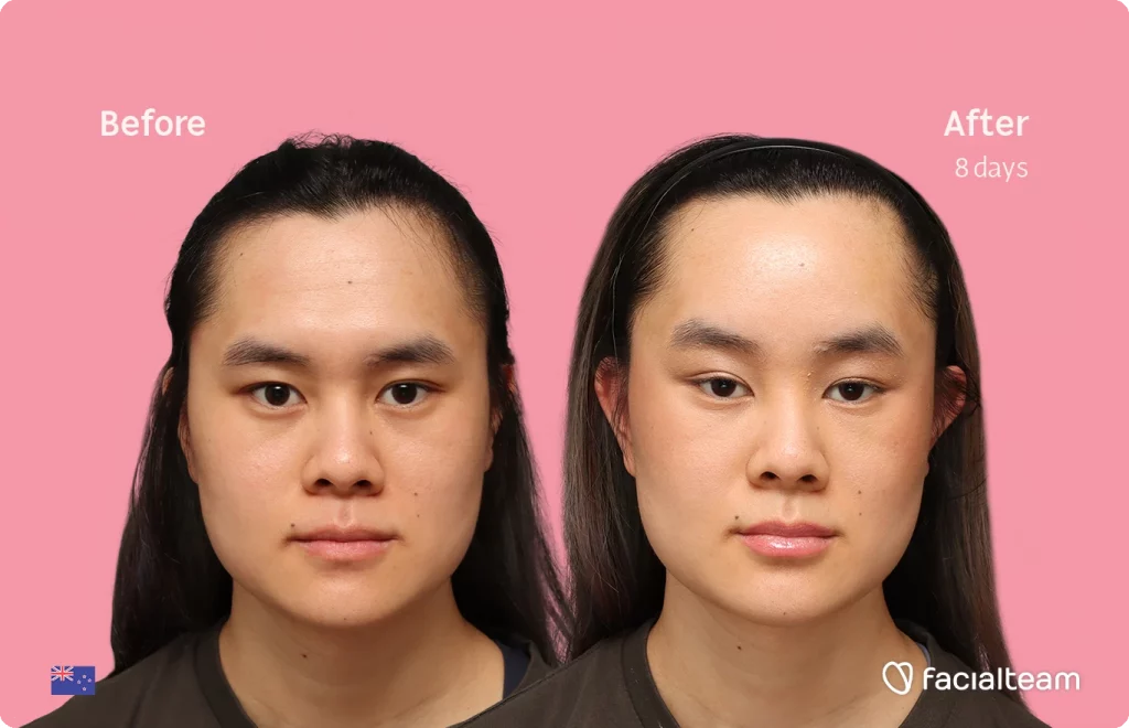 Frontal image of FFS patient Val showing the results before-after with Facialteam consisting of forehead feminization surgery.