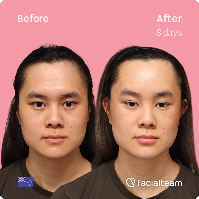 Frontal square image of FFS patient Val showing the results before-after with Facialteam consisting of forehead feminization surgery.