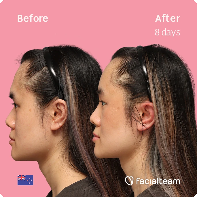 Side left square image of FFS patient Val showing the results before-after with Facialteam consisting of forehead feminization surgery.