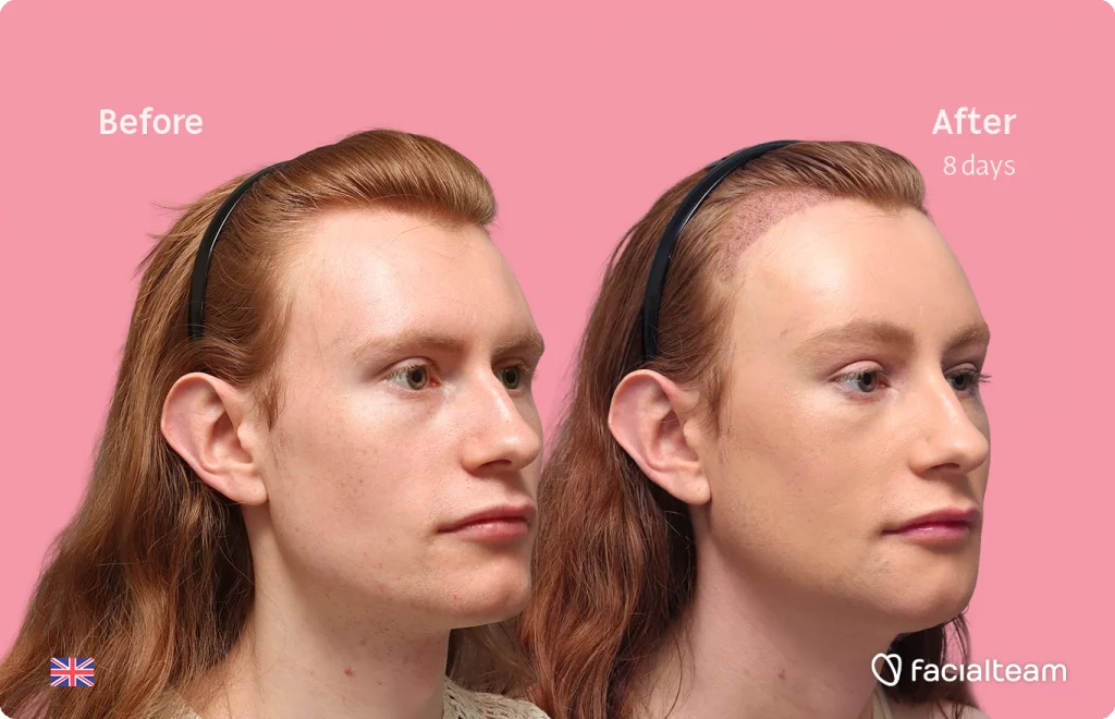 Angled right image of FFS patient Annah showing the results before and after with Facialteam, consisting of forehead feminization with simultaneous hair transplant (SHT), chin recontouring, jaw contouring, and tracheal shave.