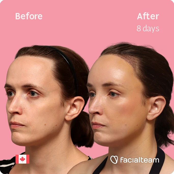 Angled left square image of FFS patient Erin showing the results before-after with Facialteam consisting of Forehead with SHT.