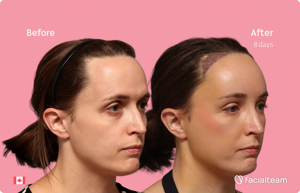 Angled right image of FFS patient Erin showing the results before-after with Facialteam consisting of Forehead with SHT.