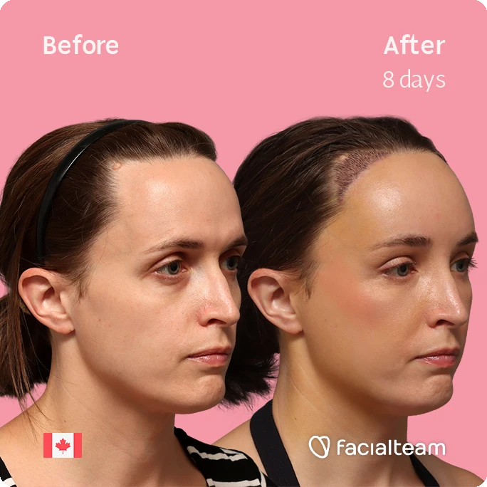Angled right square image of FFS patient Erin showing the results before-after with Facialteam consisting of Forehead with SHT.