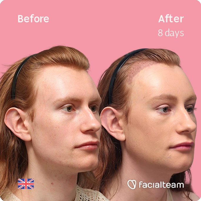 Angled right square image of FFS patient Annah showing the results before and after with Facialteam, consisting of forehead feminization with simultaneous hair transplant (SHT), chin recontouring, jaw contouring, and tracheal shave.