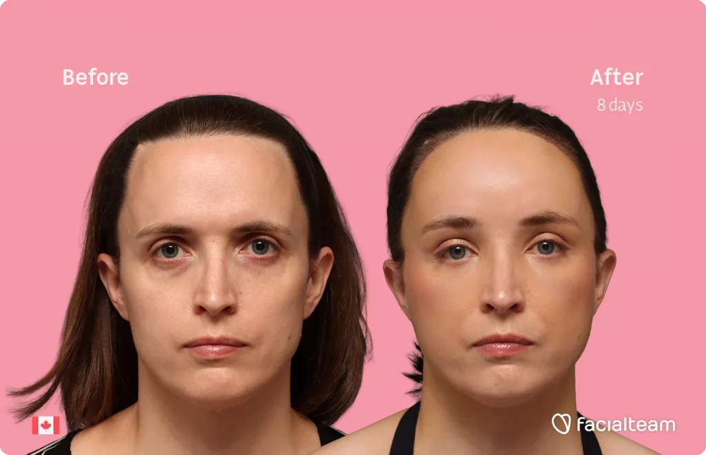 Frontal image of FFS patient Erin showing the results before-after with Facialteam consisting of Forehead with SHT.