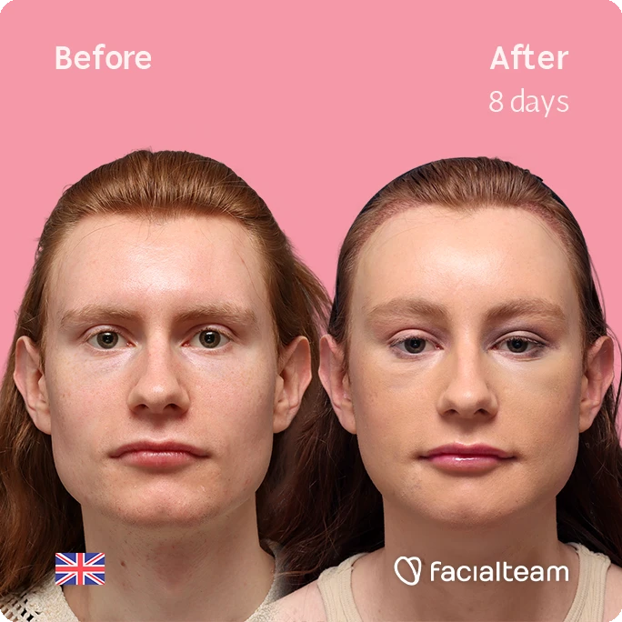 Front square image of FFS patient Annah showing the results before and after with Facialteam, consisting of forehead feminization with simultaneous hair transplant (SHT), chin recontouring, jaw contouring, and tracheal shave.